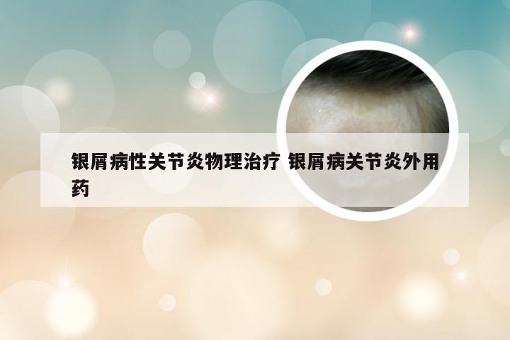 银屑病性关节炎物理治疗 银屑病关节炎外用药