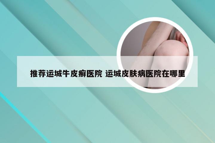 推荐运城牛皮癣医院 运城皮肤病医院在哪里