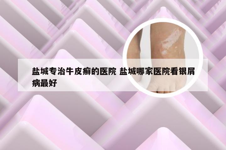 盐城专治牛皮癣的医院 盐城哪家医院看银屑病最好