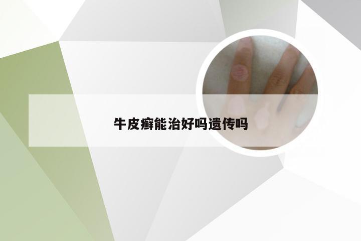 牛皮癣能治好吗遗传吗