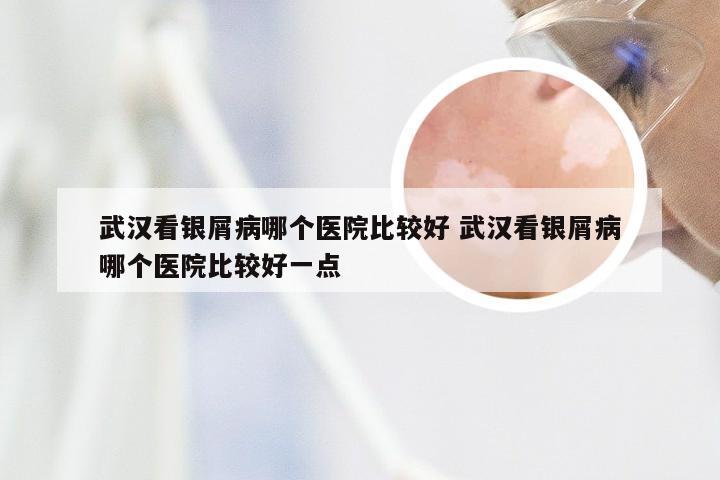 武汉看银屑病哪个医院比较好 武汉看银屑病哪个医院比较好一点