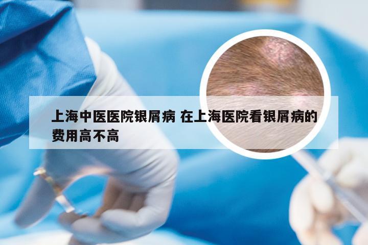 上海中医医院银屑病 在上海医院看银屑病的费用高不高