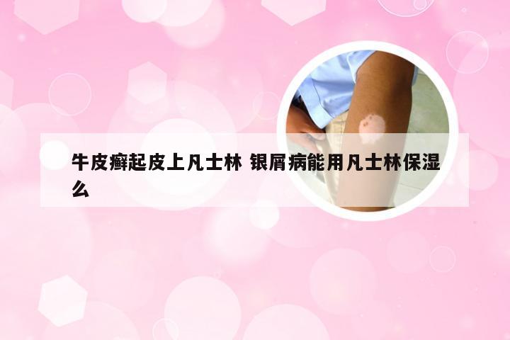 牛皮癣起皮上凡士林 银屑病能用凡士林保湿么