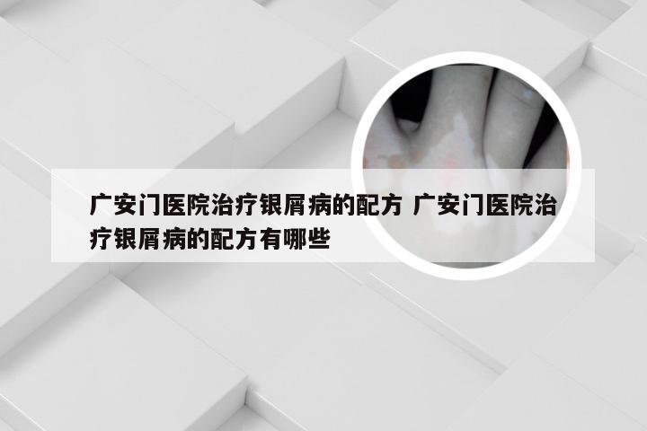 广安门医院治疗银屑病的配方 广安门医院治疗银屑病的配方有哪些