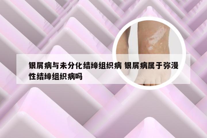 银屑病与未分化结缔组织病 银屑病属于弥漫性结缔组织病吗