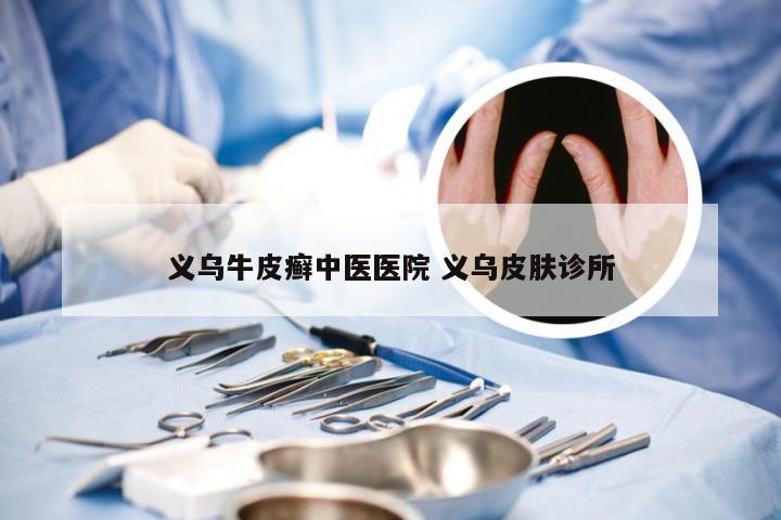 义乌牛皮癣中医医院 义乌皮肤诊所