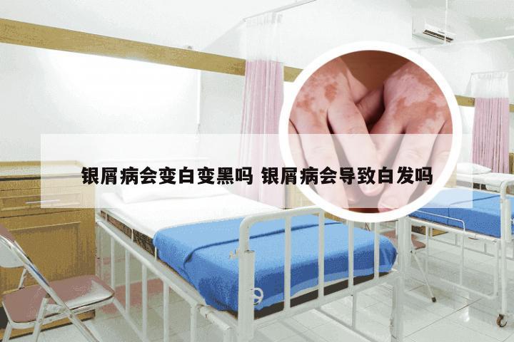 银屑病会变白变黑吗 银屑病会导致白发吗