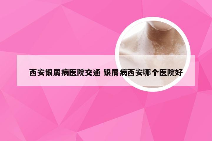 西安银屑病医院交通 银屑病西安哪个医院好
