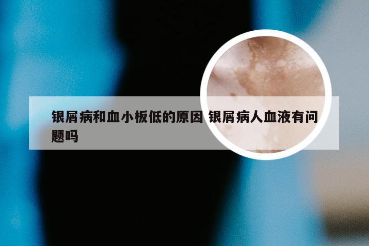 银屑病和血小板低的原因 银屑病人血液有问题吗