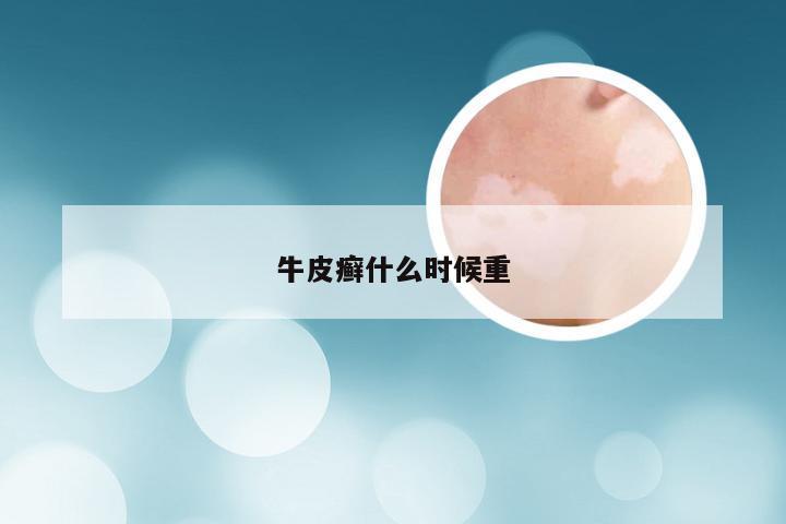 牛皮癣什么时候重