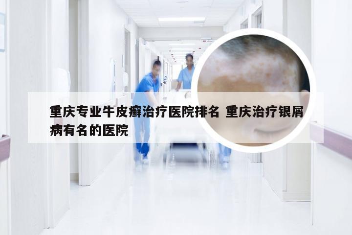 重庆专业牛皮癣治疗医院排名 重庆治疗银屑病有名的医院
