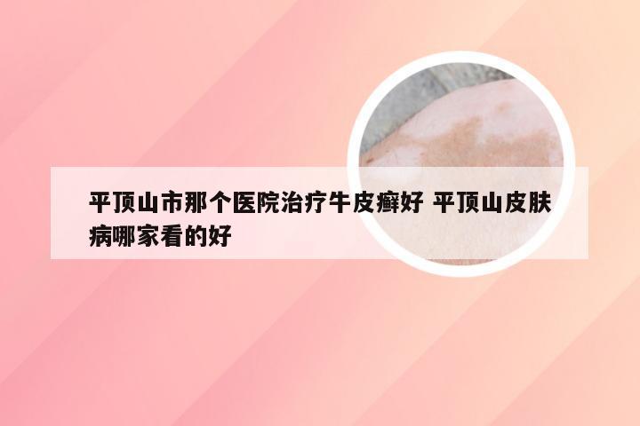 平顶山市那个医院治疗牛皮癣好 平顶山皮肤病哪家看的好