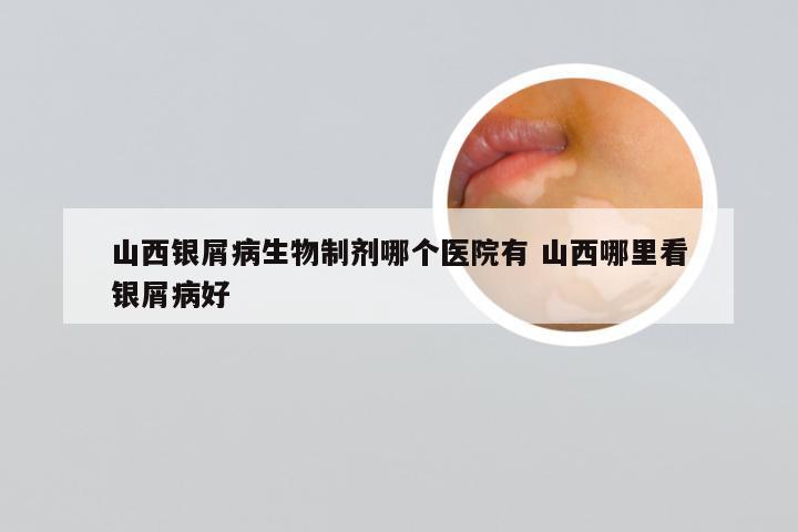 山西银屑病生物制剂哪个医院有 山西哪里看银屑病好