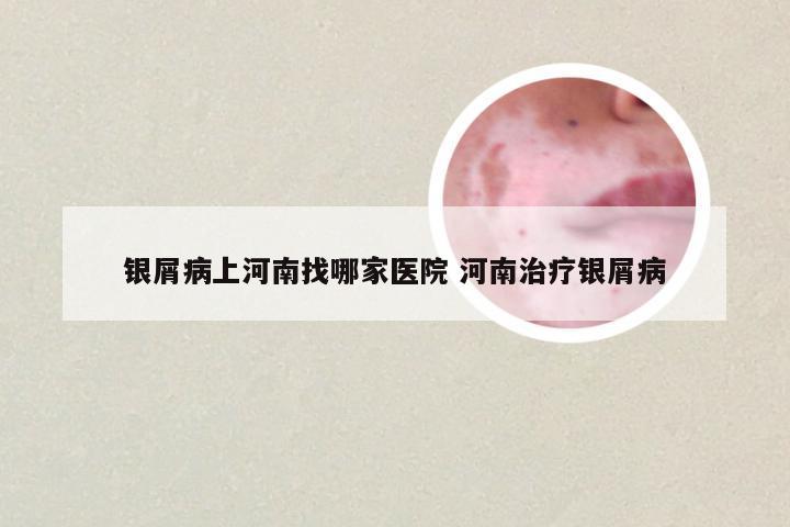 银屑病上河南找哪家医院 河南治疗银屑病