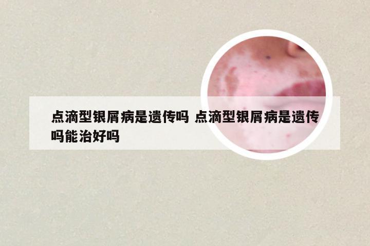 点滴型银屑病是遗传吗 点滴型银屑病是遗传吗能治好吗