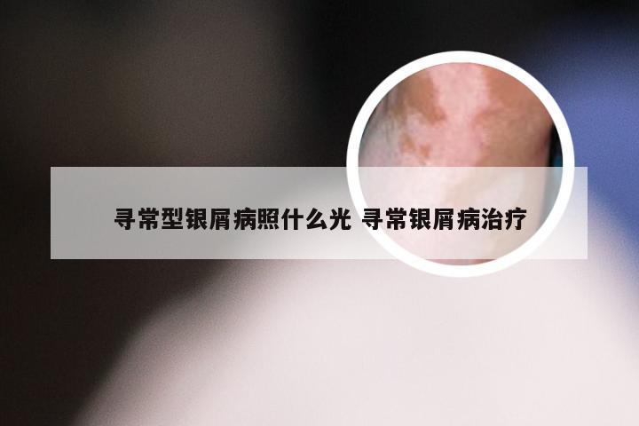 寻常型银屑病照什么光 寻常银屑病治疗
