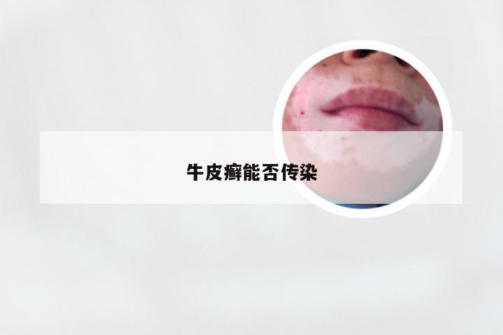 牛皮癣能否传染