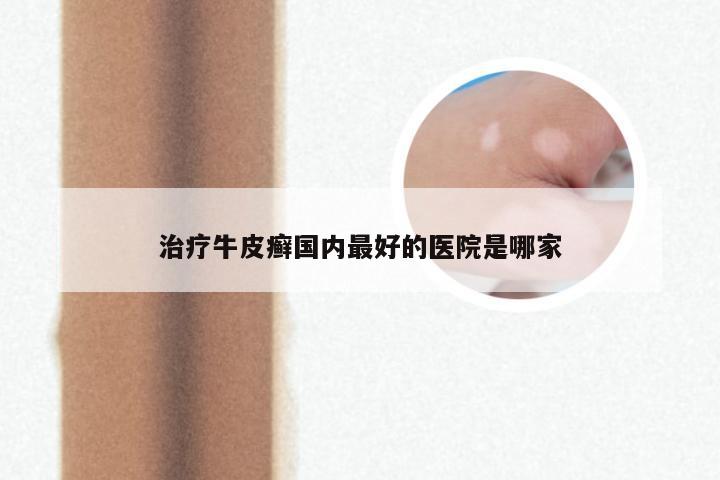 治疗牛皮癣国内最好的医院是哪家