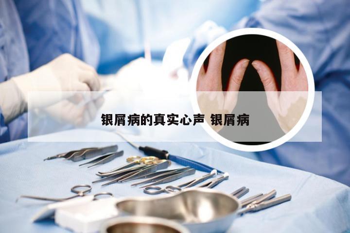 银屑病的真实心声 银屑病