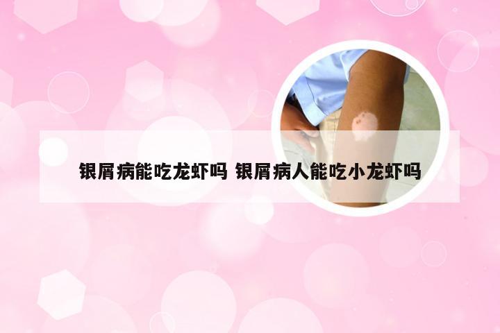 银屑病能吃龙虾吗 银屑病人能吃小龙虾吗