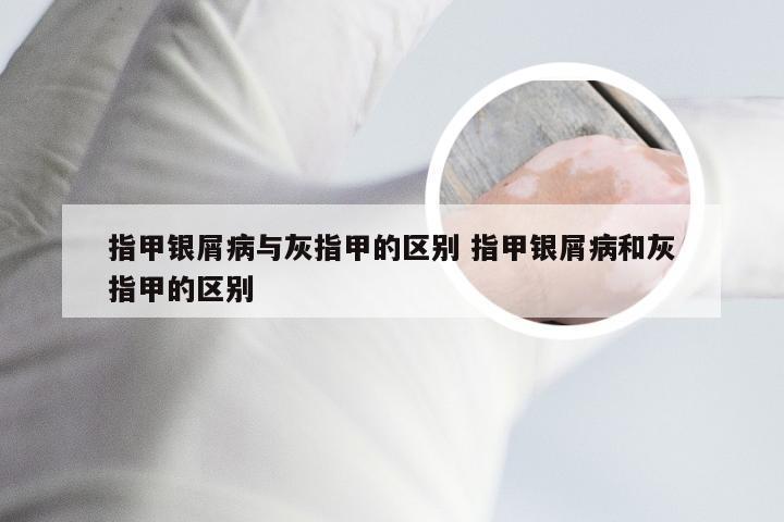 指甲银屑病与灰指甲的区别 指甲银屑病和灰指甲的区别