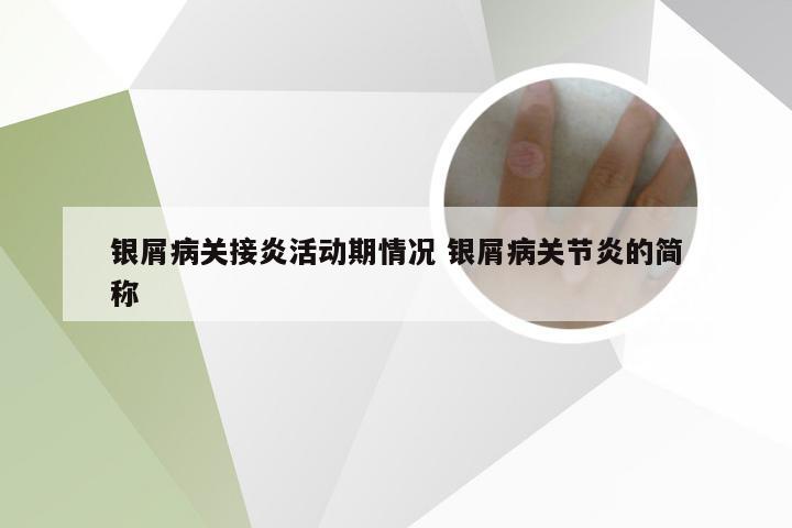 银屑病关接炎活动期情况 银屑病关节炎的简称