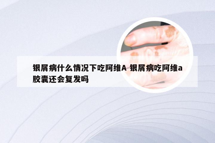 银屑病什么情况下吃阿维A 银屑病吃阿维a胶囊还会复发吗