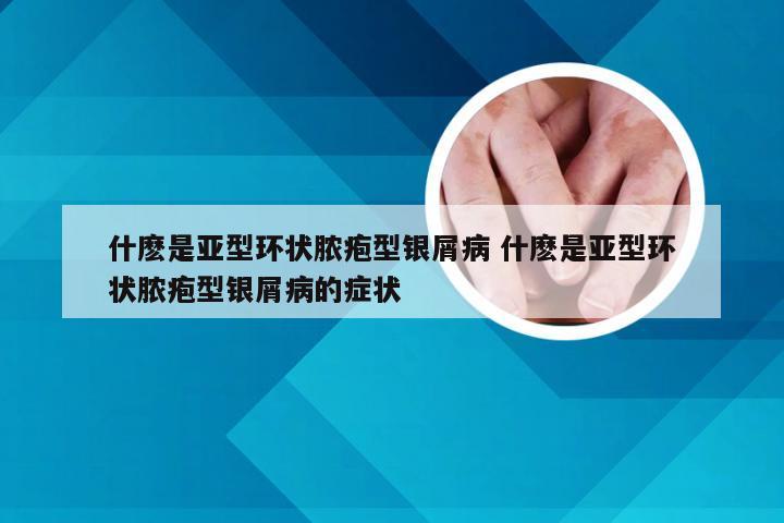 什麽是亚型环状脓疱型银屑病 什麽是亚型环状脓疱型银屑病的症状