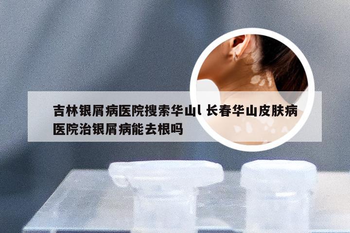 吉林银屑病医院搜索华山l 长春华山皮肤病医院治银屑病能去根吗