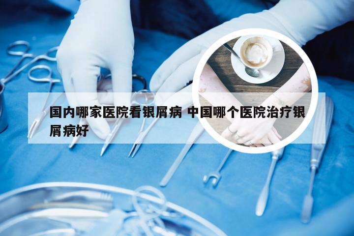 国内哪家医院看银屑病 中国哪个医院治疗银屑病好