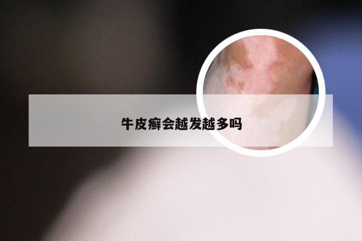牛皮癣会越发越多吗