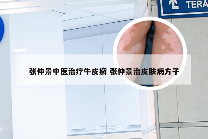 张仲景中医治疗牛皮癣 张仲景治皮肤病方子