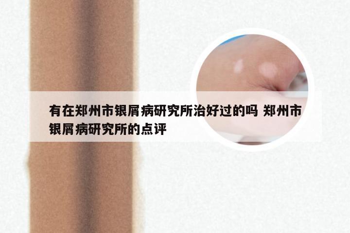 有在郑州市银屑病研究所治好过的吗 郑州市银屑病研究所的点评