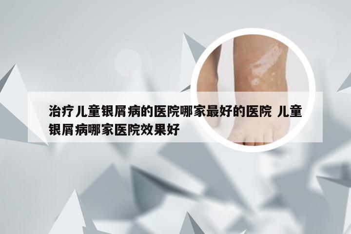 治疗儿童银屑病的医院哪家最好的医院 儿童银屑病哪家医院效果好