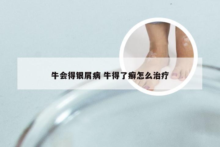 牛会得银屑病 牛得了癣怎么治疗