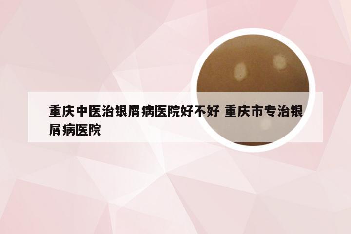 重庆中医治银屑病医院好不好 重庆市专治银屑病医院