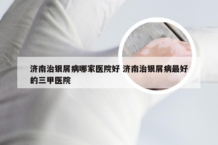 济南治银屑病哪家医院好 济南治银屑病最好的三甲医院