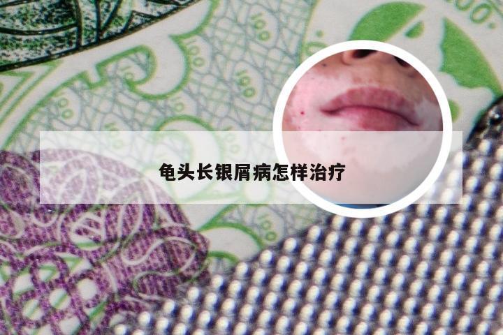 龟头长银屑病怎样治疗
