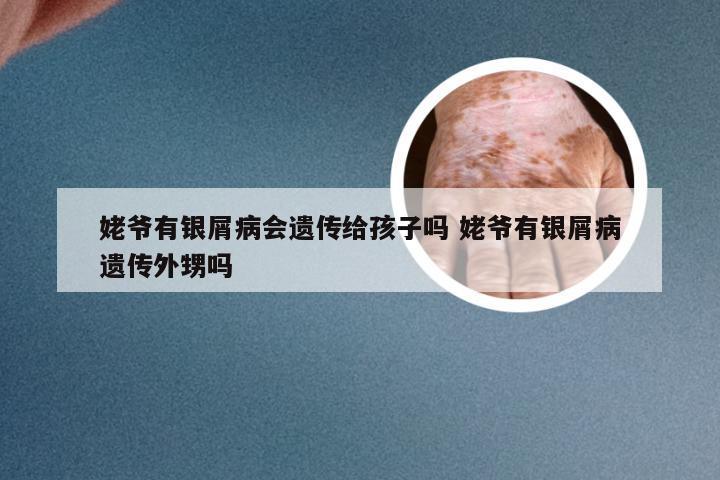 姥爷有银屑病会遗传给孩子吗 姥爷有银屑病遗传外甥吗