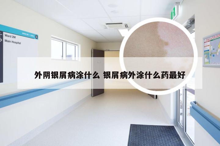 外阴银屑病涂什么 银屑病外涂什么药最好