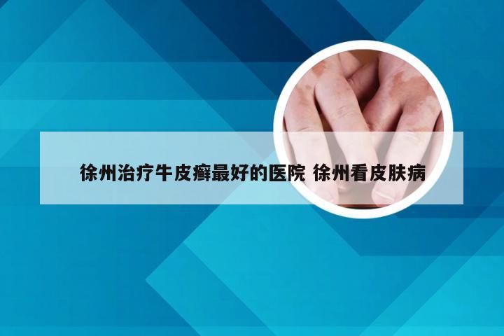 徐州治疗牛皮癣最好的医院 徐州看皮肤病