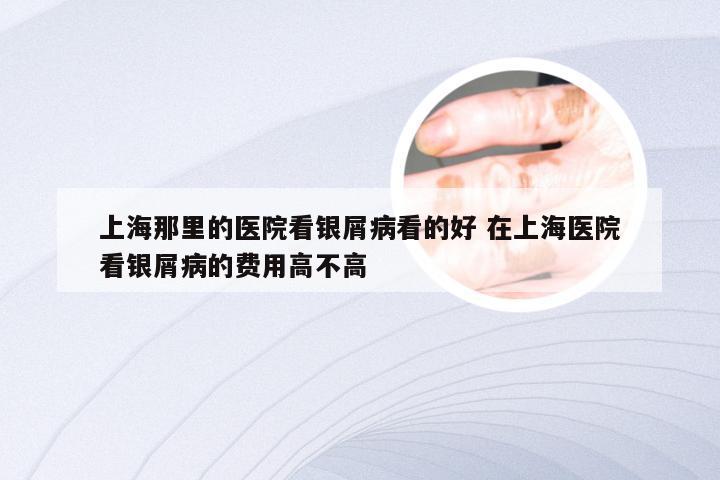 上海那里的医院看银屑病看的好 在上海医院看银屑病的费用高不高