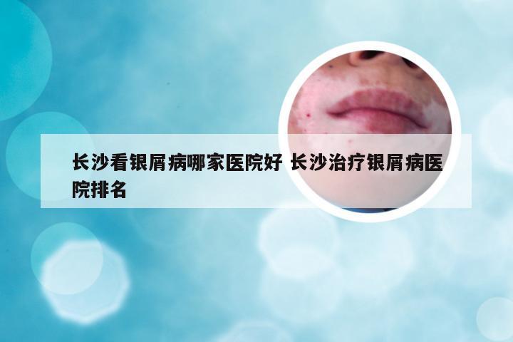 长沙看银屑病哪家医院好 长沙治疗银屑病医院排名