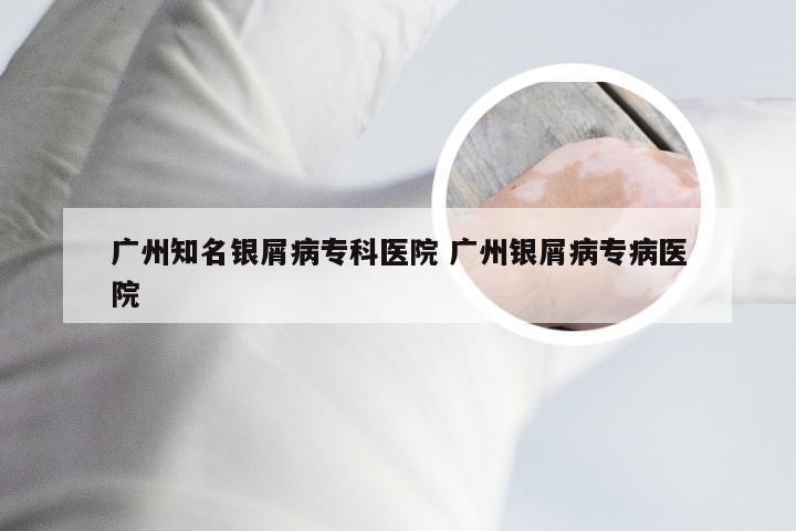 广州知名银屑病专科医院 广州银屑病专病医院