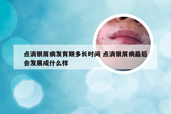 点滴银屑病发育期多长时间 点滴银屑病最后会发展成什么样