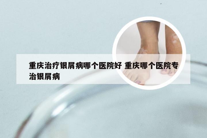 重庆治疗银屑病哪个医院好 重庆哪个医院专治银屑病