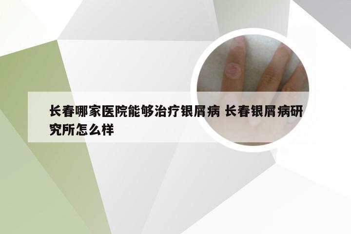 长春哪家医院能够治疗银屑病 长春银屑病研究所怎么样