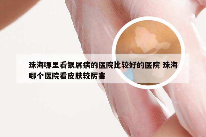 珠海哪里看银屑病的医院比较好的医院 珠海哪个医院看皮肤较厉害