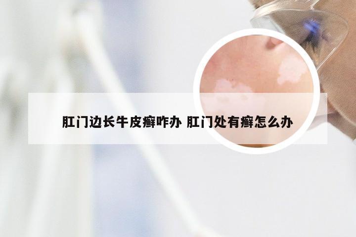 肛门边长牛皮癣咋办 肛门处有癣怎么办