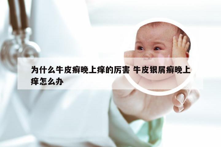 为什么牛皮癣晚上痒的厉害 牛皮银屑癣晚上痒怎么办
